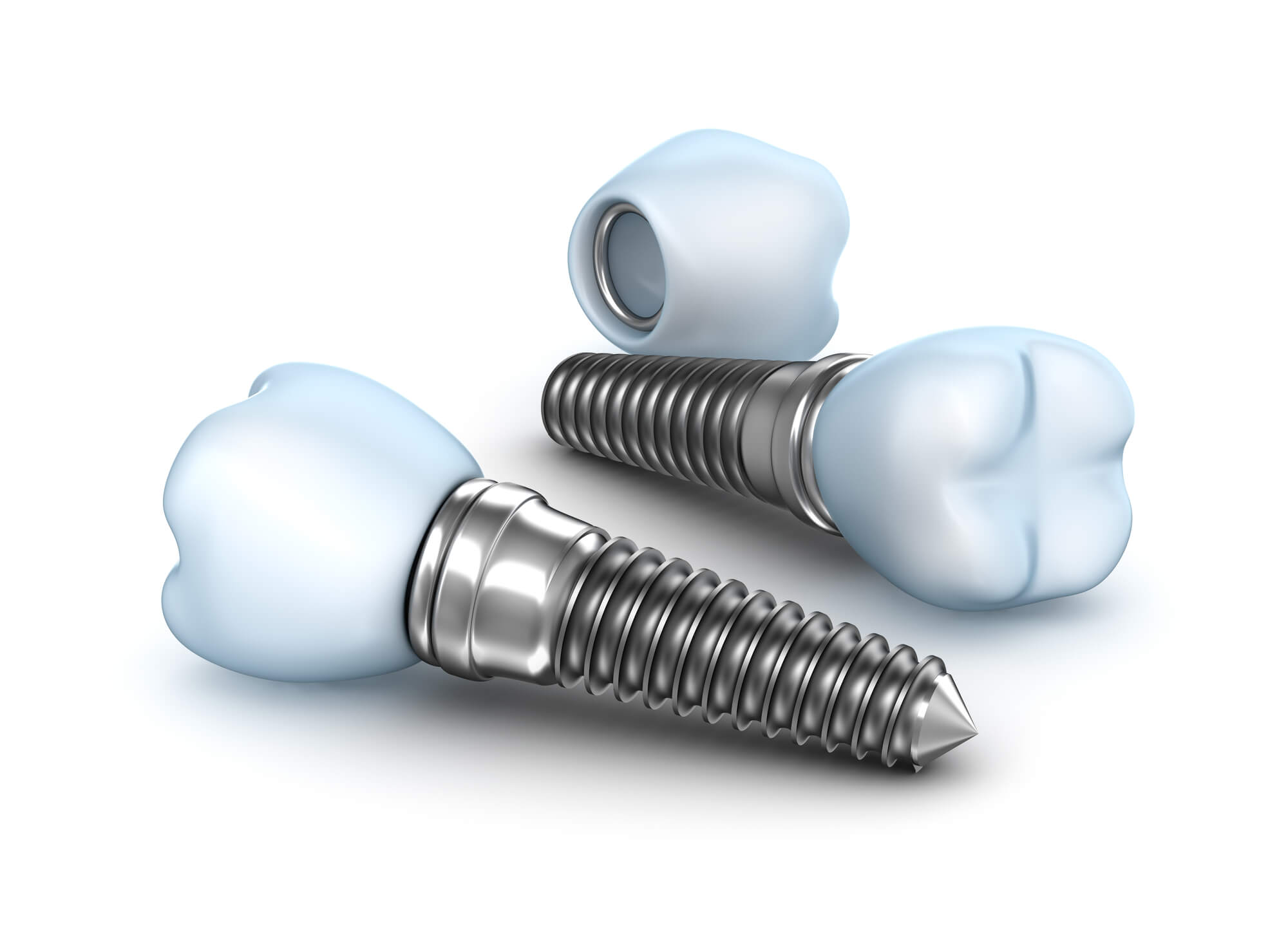 Are There Any Downsides To Dental Implants