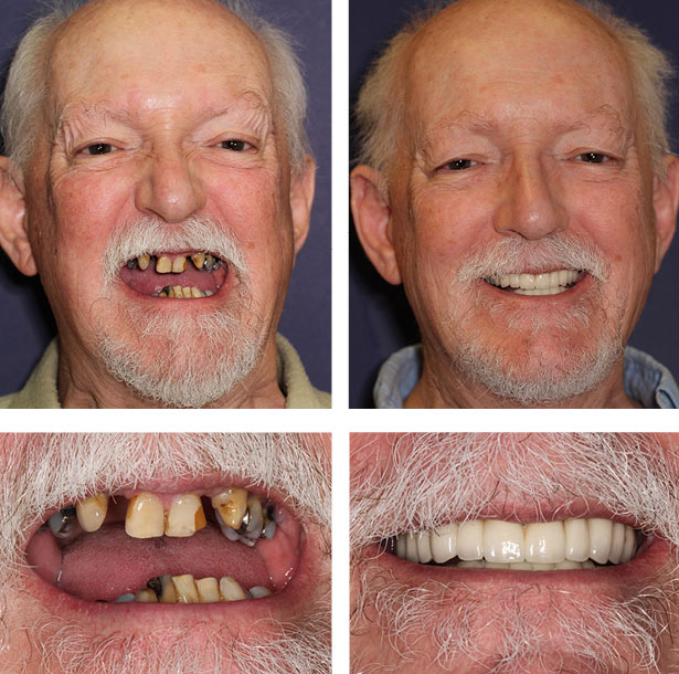 A collage of before and after photos of an elderly male patient of PGA Dentistry.