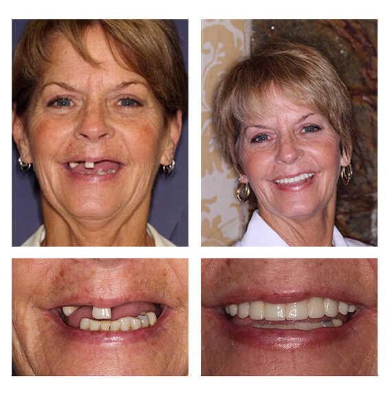 A collage of before and after photos of a female patient of PGA Dentistry.