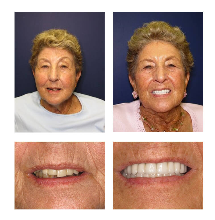 A collage of before and after photos of an elderly female patient of PGA Dentistry.