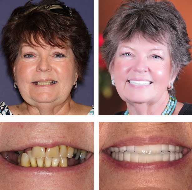 A collage of before and after photos of a female patient of PGA Dentistry.