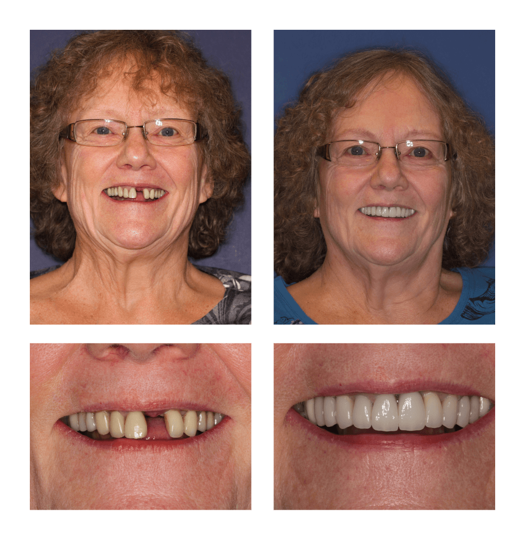 Single Tooth Replacement