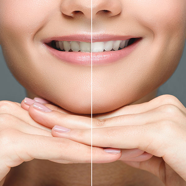 Teeth Whitening